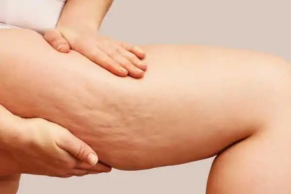 Image of woman showing leg with cellulite Ilkeston