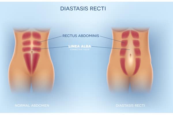 What Non-Surgical Options Are Available for Diastasis Recti Ilkeston?