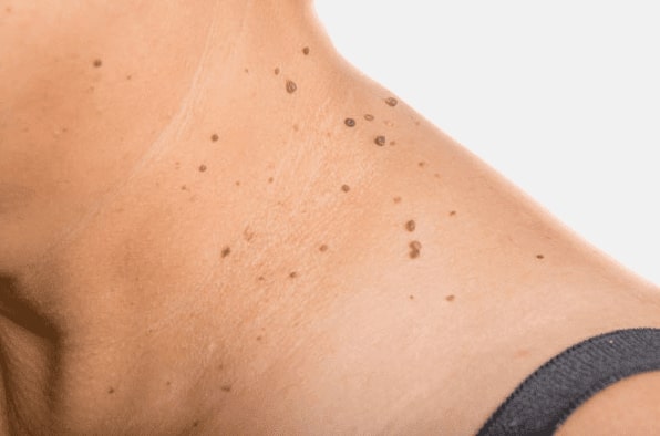 Are you looking for easy skin tag removal Ilkeston - then contact Spire today!