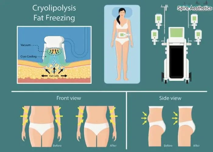 Fat freezing treatment Ilkeston benefits for competitions to remove stubborn fat deposits.