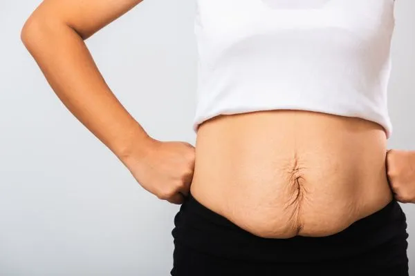Image of a woman's stomach after weight loss with sagging skin following a gastric band Ilkeston
